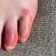 A teenage patient’s foot soon after the start of her symptoms.